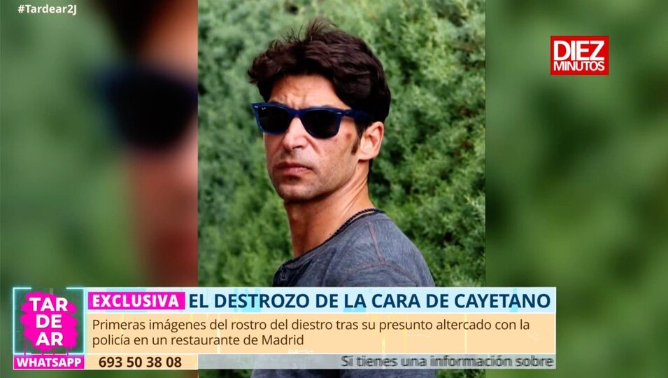 Cayetano con el hematoma | Foto: telecinco.es