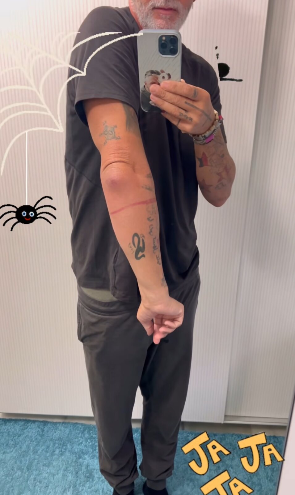 Carlos Alba enseña su brazo inflamado | Fotografía: Telecinco