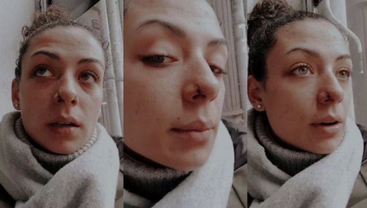 Cicatrices del ataque de un perro a Paula Casti 'MYHYV')