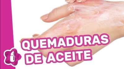 Quemaduras de aceite: qué hacer y qué no hacer