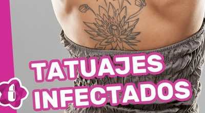 Tatuajes infectados: tratamiento y cura