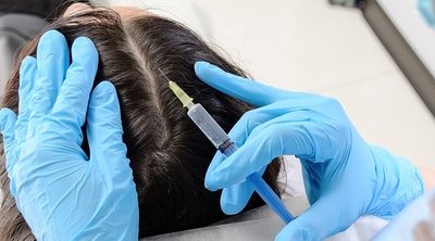 Tratamientos para frenar la caída del pelo, ¿son permanentes?