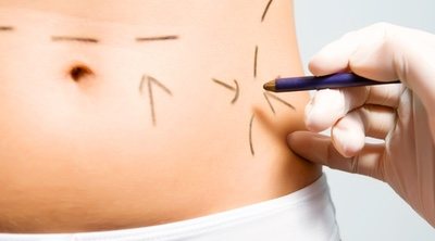 Lipo4D: edad recomendada y resultado en función de la edad